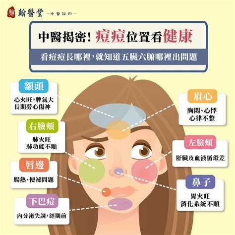 長痘痘位置|消除臉上痘痘、痘疤 醫告訴你「治療關鍵」！快避開。